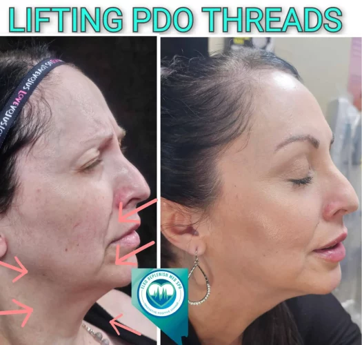 PDO thread lift results in Elko, NV, showing lifted skin and reduced sagging.