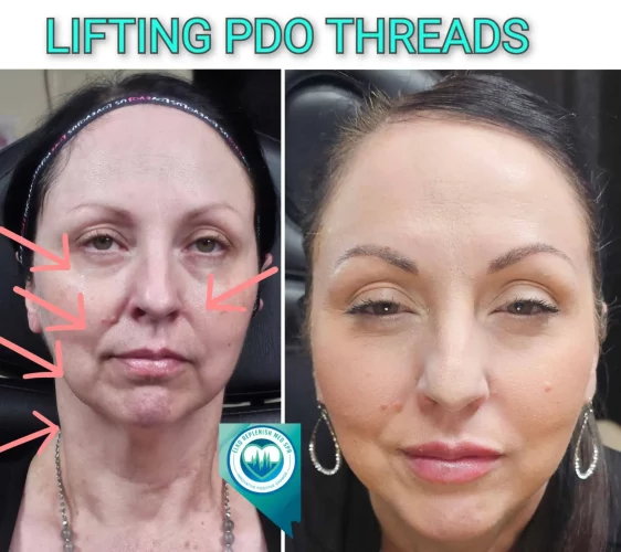 PDO thread lifting results in Elko, NV, showing reduced sagging and a more youthful appearance.