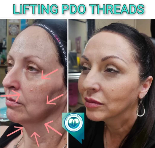 Before and after PDO thread lifting results in Elko, NV showing enhanced facial definition.