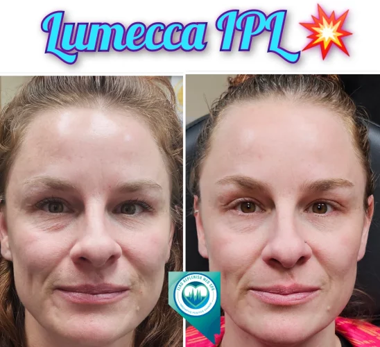 Lumecca IPL Before and after Treatment | Elko Replenish Med Spa | Elko, NV