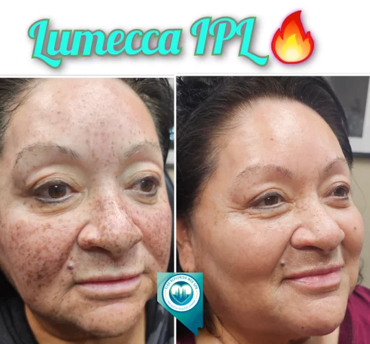 Lumecca Before and after Treatment | Elko Replenish Med Spa | Elko, NV