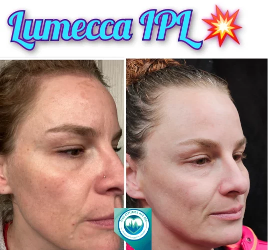 Lumecca IPL | Elko Replenish Med Spa | Elko, NV