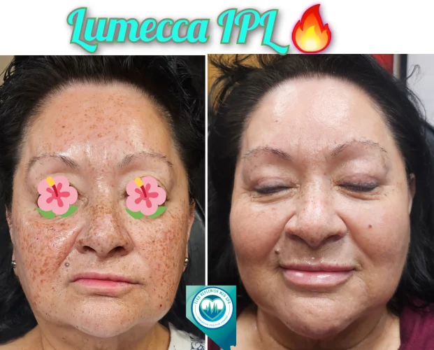 IPL Lumecca Before after Treatment | Elko Replenish Med Spa | Elko, NV