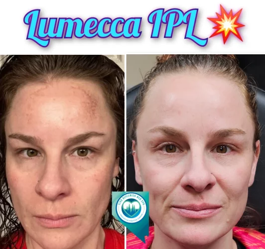 Lumecca IPL Before after Treatment | Elko Replenish Med Spa | Elko, NV