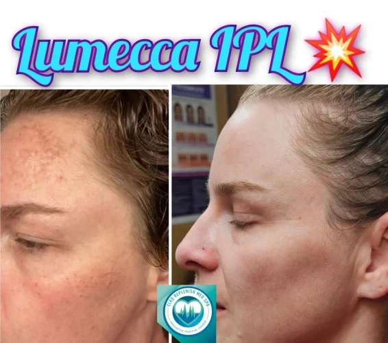 Lumecca Before after Treatment | Elko Replenish Med Spa | Elko, NV