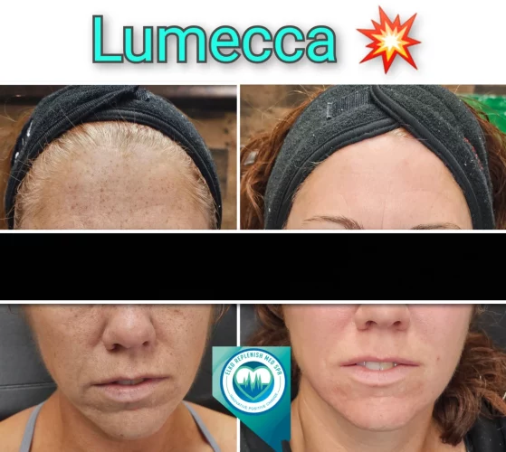 Lumecca before and after images 1 | Elko Replenish Med Spa | Elko, NV