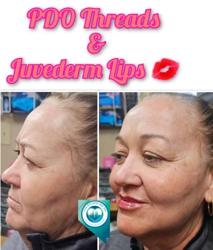 PDO Threads | Juvederm Lips | Elko Replenish Med Spa | Elko, NV