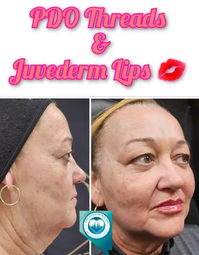 PDO Threads and Juvederm Lips | Elko Replenish Med Spa | Elko, NV