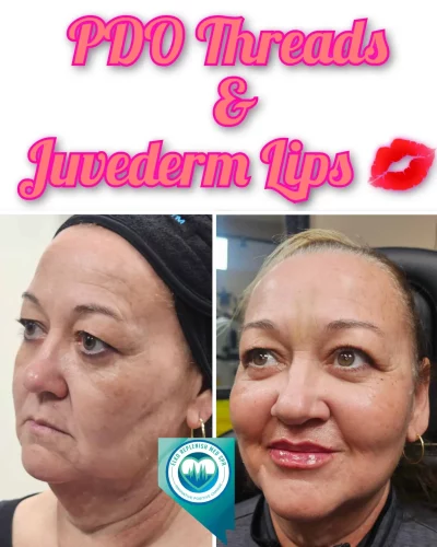 PDO Threads Before And After Juvederm Lips | Elko Replenish Med Spa | Elko, NV