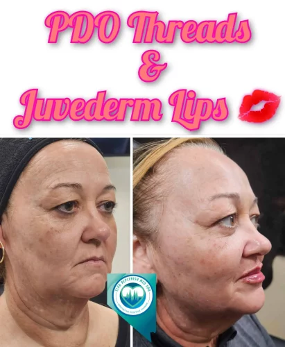 PDO Threads and Juvederm Lips | Elko Replenish Med Spa | Elko, NV