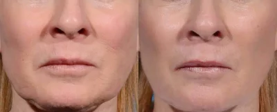 Before and After Morpheus8 Fine Lines | Elko Replenish Med Spa | Elko, NV