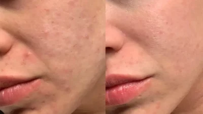 Before and After Morpheus8 | Elko Replenish Med Spa | Elko, NV