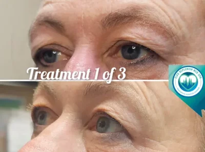 Before and After Tear troughs | Elko Replenish Med Spa | Elko, NV