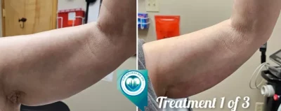 Before and After Arms | Elko Replenish Med Spa | Elko, NV