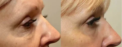 Under eye Before and After | Elko Replenish Med Spa | Elko, NV