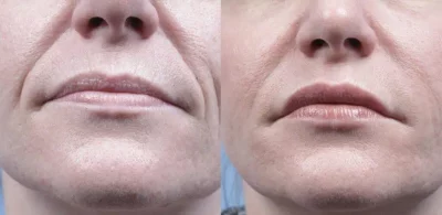 Morpheus8 Before and After Facial Wrinkles | Elko Replenish Med Spa | Elko, NV