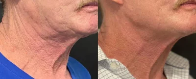 Before and After Morpheus8 Neck Fat Reduction | Elko Replenish Med Spa | Elko, NV