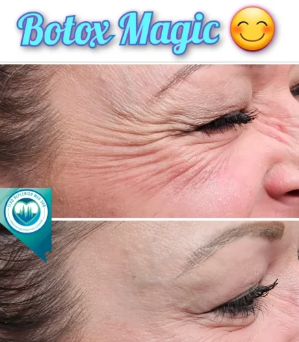 Botox for Wrinkles | Elko Replenish Med Spa | Elko, NV