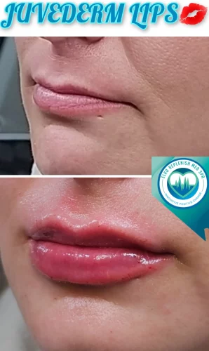 Juvederm | Lips Treatment | Elko Replenish Med Spa | Elko, NV