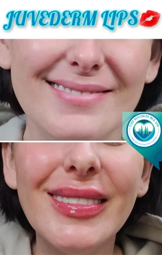 Juvederm Lips Treatment | Elko Replenish Med Spa | Elko, NV