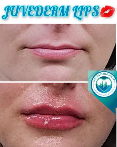 Juvederm Lips | Elko Replenish Med Spa | Elko, NV