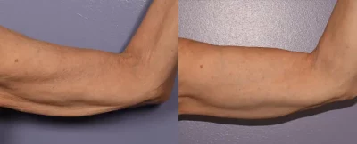 Morphues8 Arm fat reduction | Elko Replenish Med Spa | Elko, NV