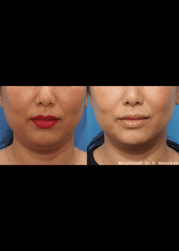 Morpheus8 Skin Tightening Before and After Images| Elko Replenish Med Spa | Elko, NV