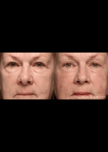 Morpheus8 Wrinkle Treatment | Elko Replenish Med Spa | Elko, NV