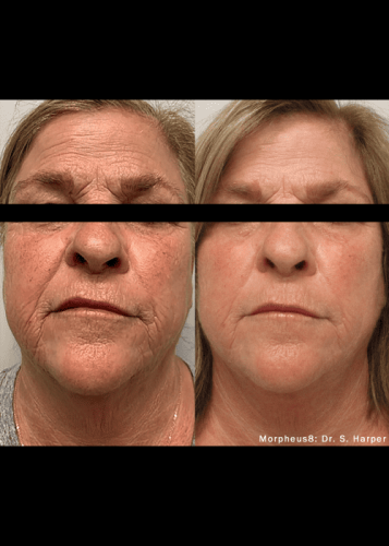 Morpheus8 Skin Tightening | Elko Replenish Med Spa | Elko, NV