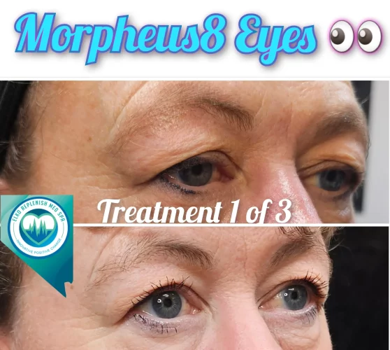 Morpheus8 Eyes Treatment | Elko Replenish Med Spa | Elko, NV