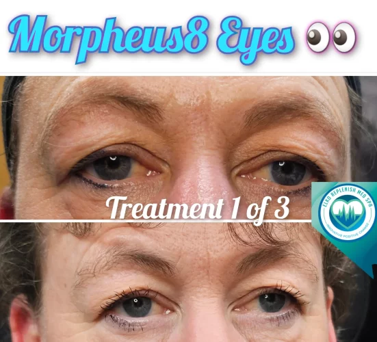 Morpheus8 Eyes | Elko Replenish Med Spa | Elko, NV