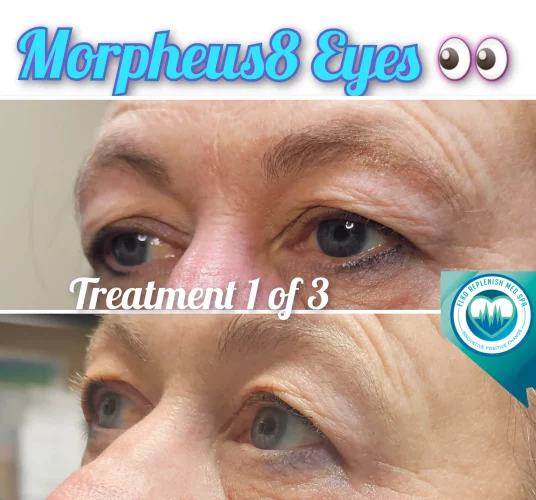 Eyes Treatment with Morpheus8 | Elko Replenish Med Spa | Elko, NV