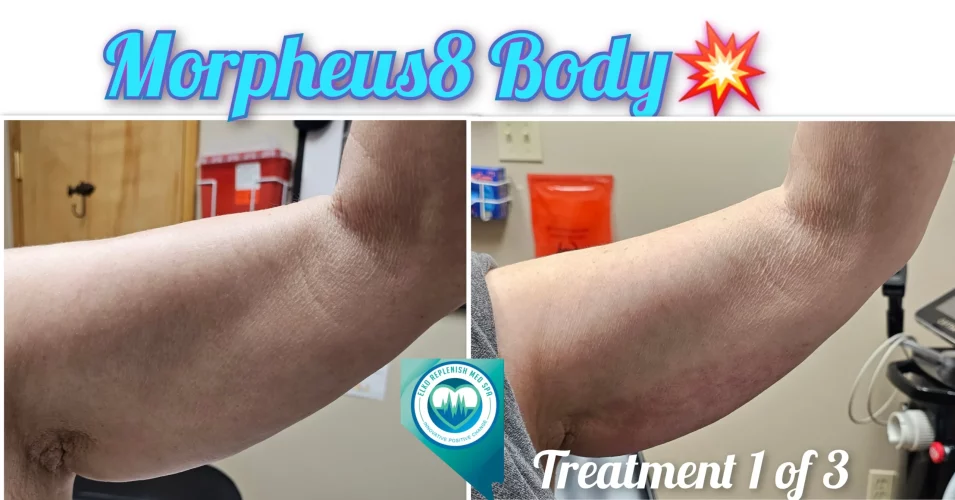 Morpheus8 Body | Elko Replenish Med Spa | Elko, NV