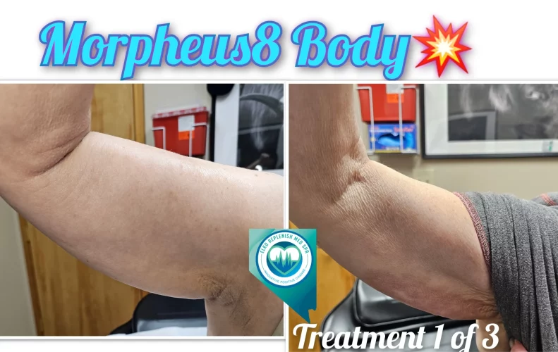 Morpheus for Arm | Elko Replenish Med Spa | Elko, NV