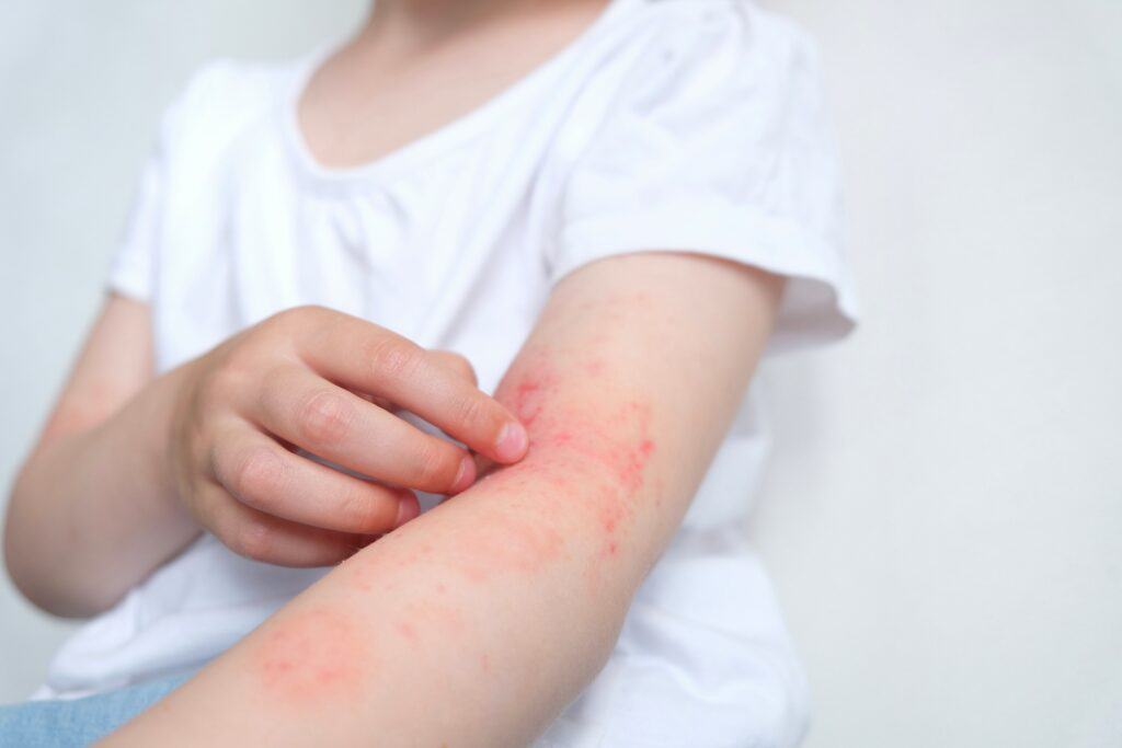 Chronic Allergy Relief Therapy | Elko Replenish Med Spa | Elko, NV