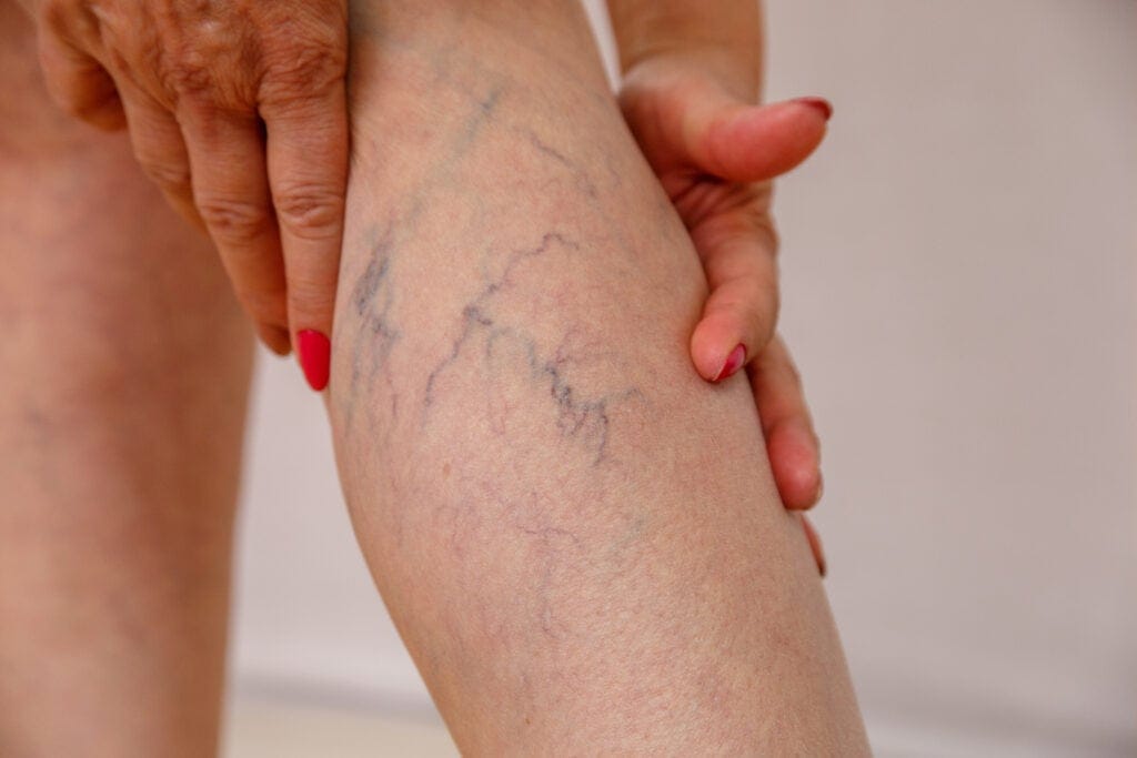 Spider Veins Treatment | Elko Replenish Med Spa | Elko, NV