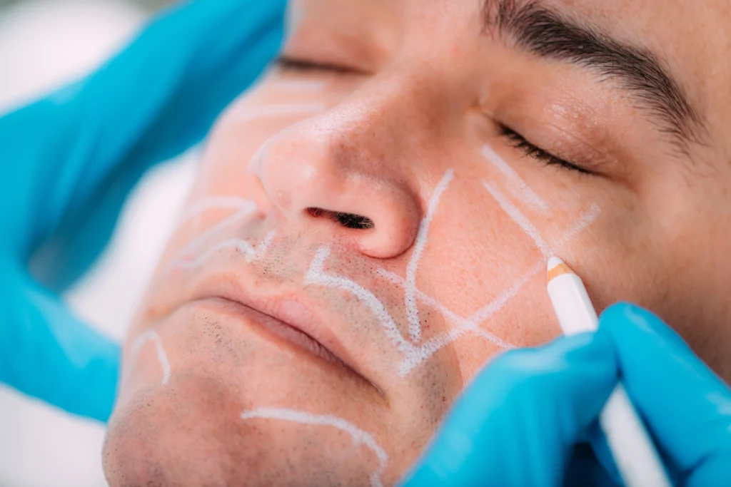 Marionette line fillers for smoother smile lines at Elko Replenish Med Spa