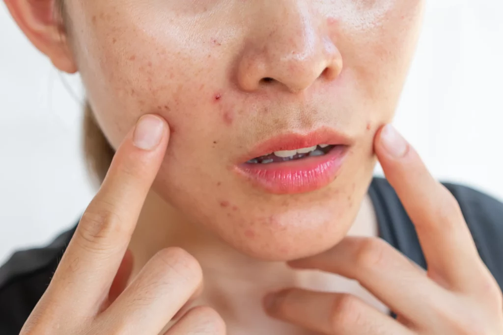 Acne scar reduction treatment targeting post-acne marks, uneven texture, and skin imperfections.