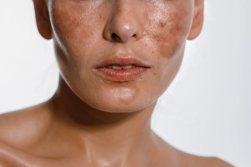 Non-invasive hyperpigmentation treatment supporting brighter, smoother, and healthier-looking skin.